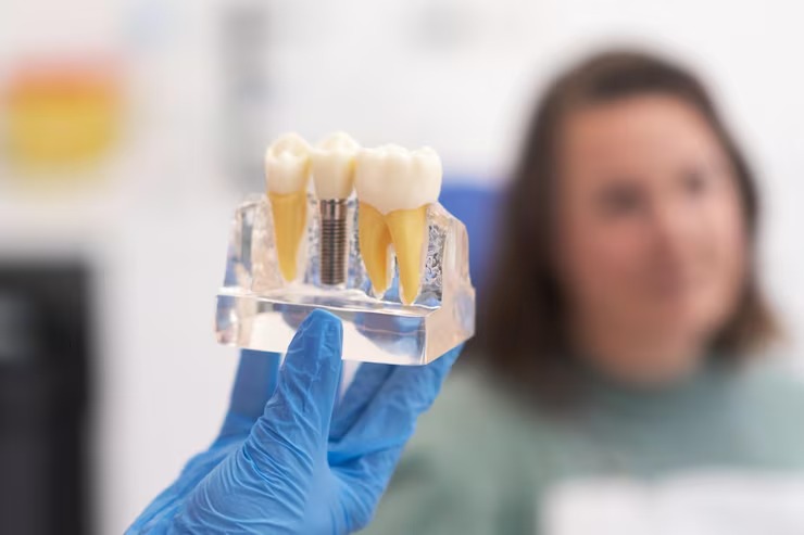 dental-implants-near-you