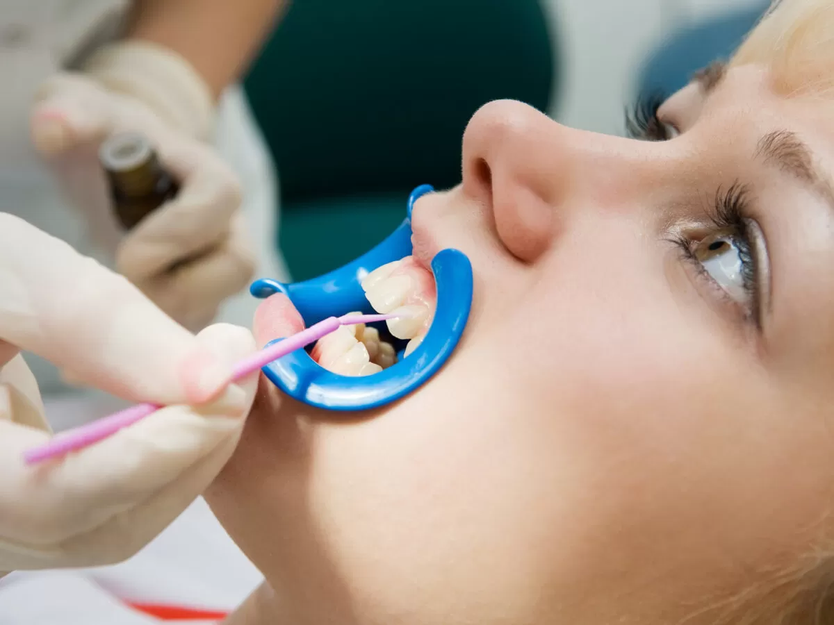 dental sealants in strathcona