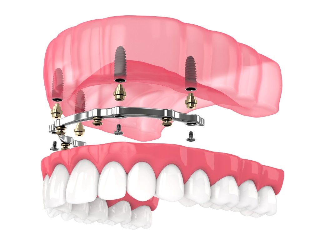 implant supported denture in strathcona