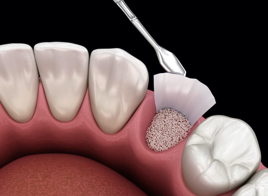 sinus lift near you