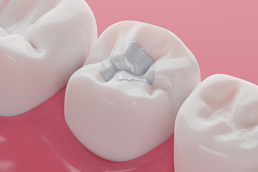 tooth coloured fillings in strathcona