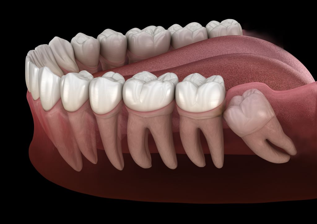 wisdom tooth extractions in strathcona edmonton