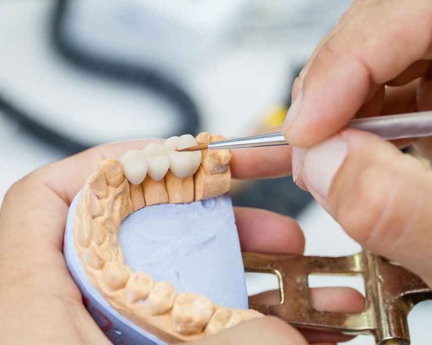 dental crowns and bridges