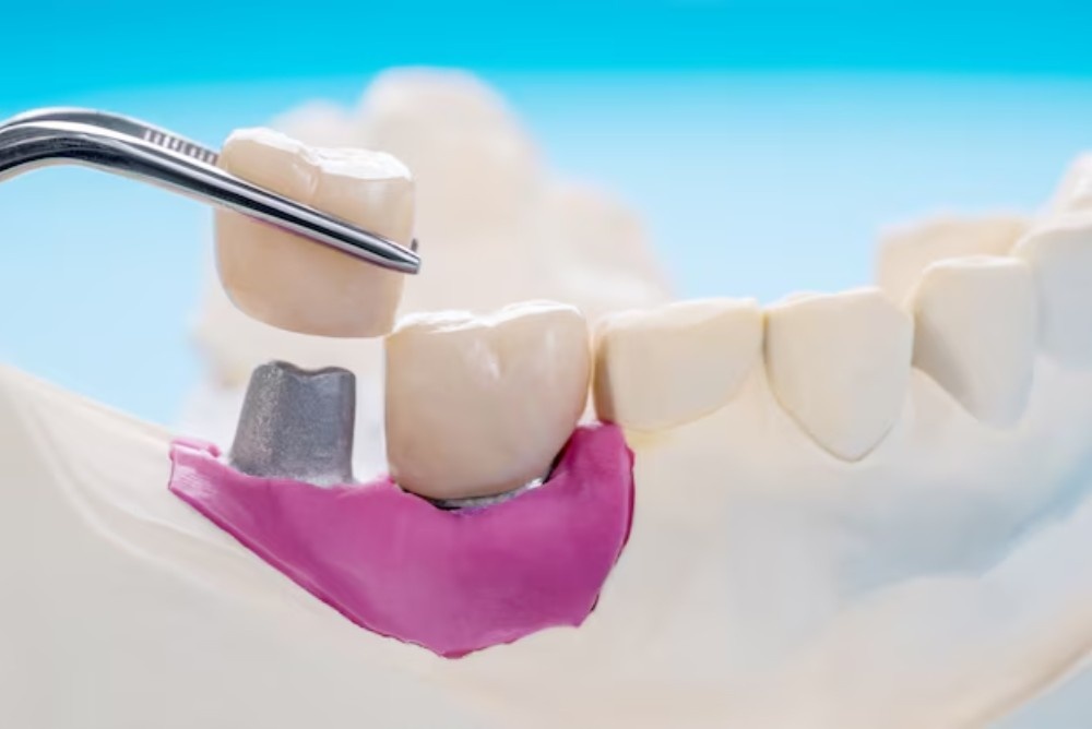 Dental Crowns Explained: Types, Treatment Process & Aftercare