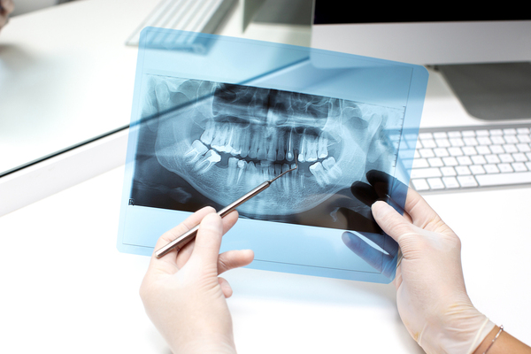 digital dental x-rays safe, fast & accurate imaging