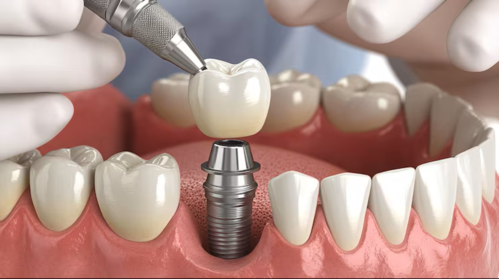 What are the Lasting Benefits of Dental Implants for Oral Health