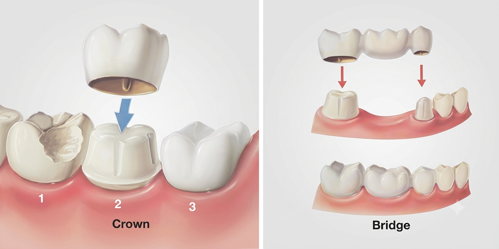 When Do You Need a Dental Crown or Bridge